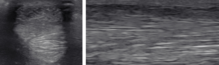 Obraz USG uszkodzenia ścięgna mięśnia zginacza palca powierzchownego przed podjęciem leczenia